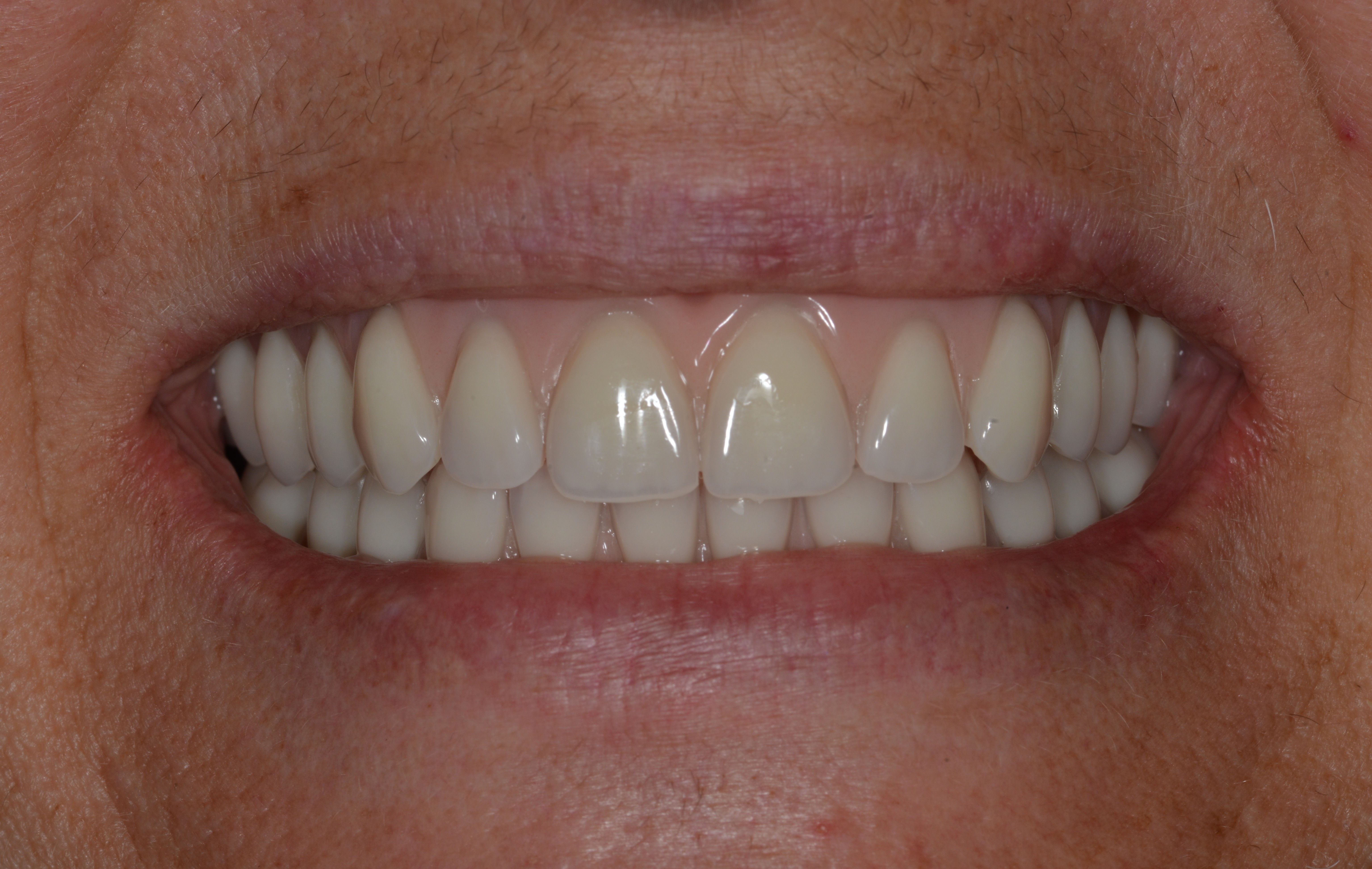 Smile 06
